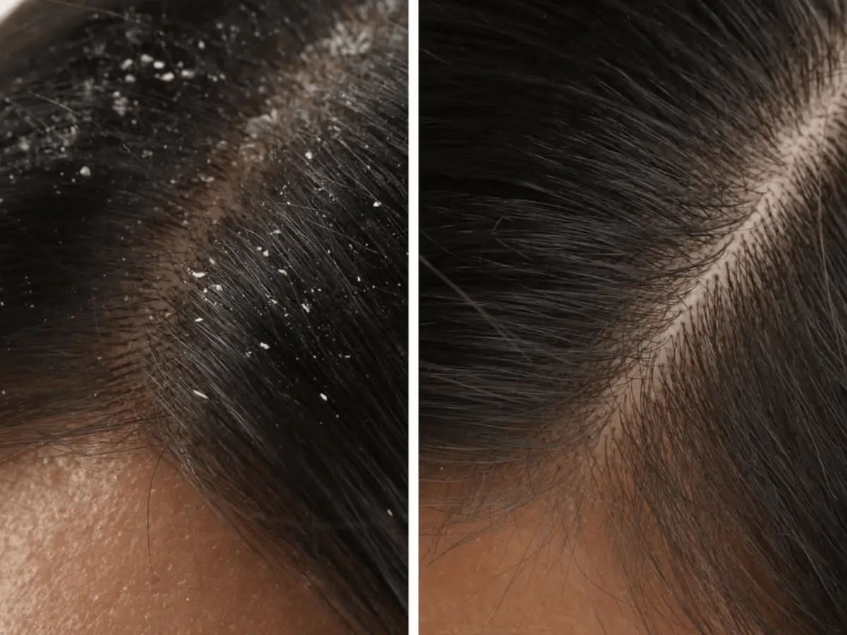 Illustration for the article: Dry Scalp or Dandruff? What Causes Winter Hair Fall and How to Tell Them Apart