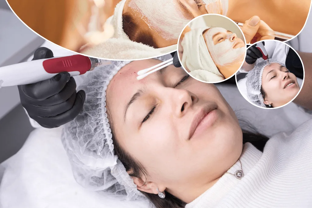 Illustration for the article: What Is Microneedling? How Collagen Induction Therapy Actually Works